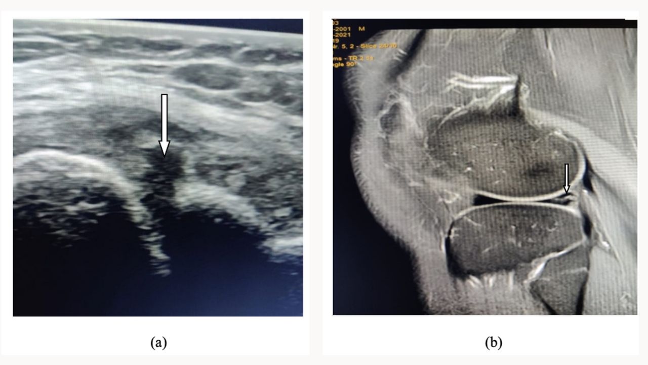 (Hình 4 - Hình siêu âm chấn thương sụn chêm (a) và rách sụn chêm (b))