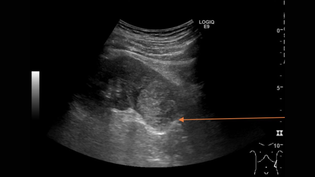 (Hình 4 - Hình ảnh mặt cắt dọc khi siêu âm cho thấy thận trái có khối u rất lớn)
