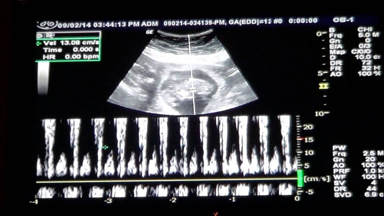 (Hình 2 - Hình ảnh siêu âm tim thai của thai nhi tuần thứ 12)