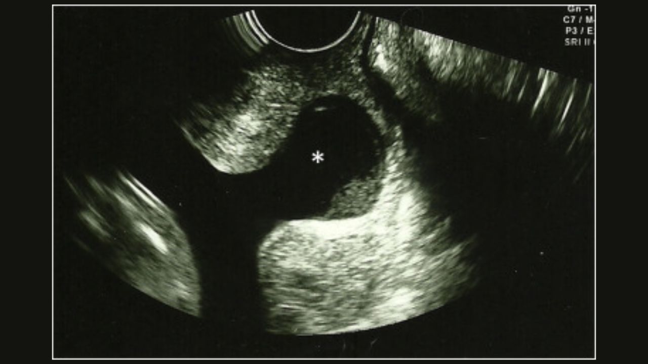 (Hình 7 - Siêu âm tử cung đầu dò phát hiện dị tật ở nội tạng ở thai nhi 22 tuần tuổi)