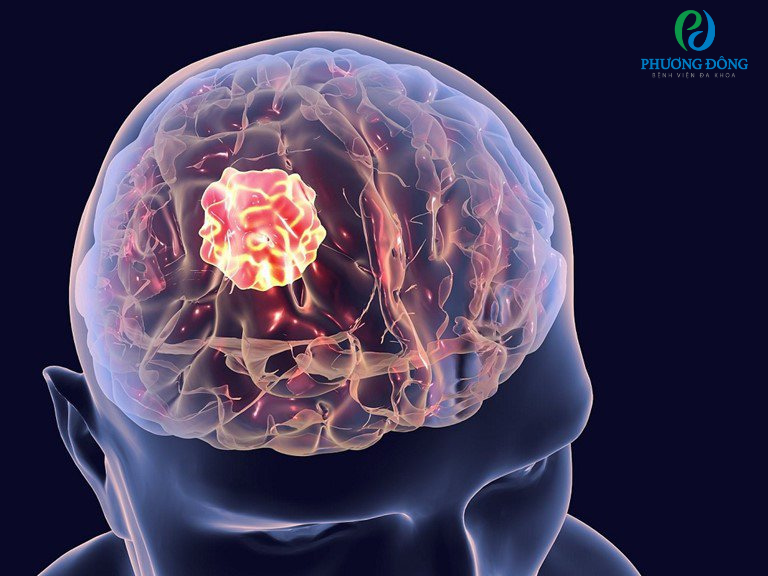 Sinh thiết não là phương pháp chẩn đoán chính xác các bệnh lý về não