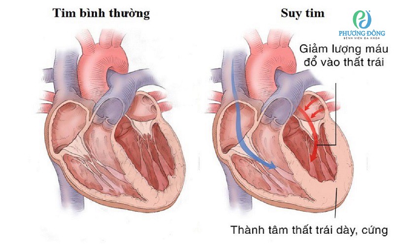  Suy tim trái là gì? 