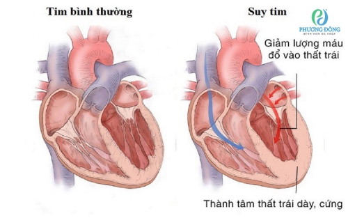  Tất tần tật về suy tim trái: Triệu chứng, biến chứng, phương pháp điều trị.