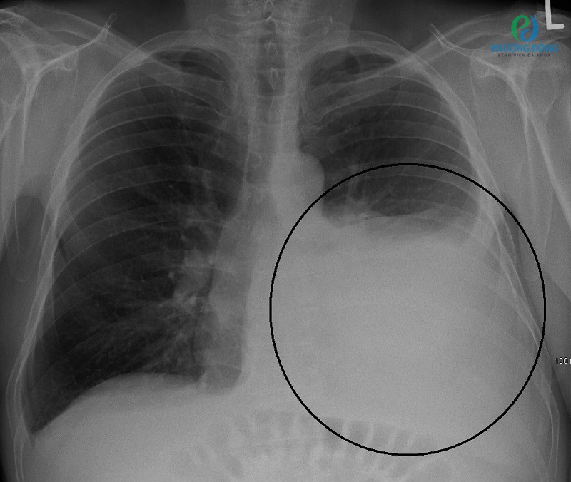Tràn dịch màng phổi là gì 