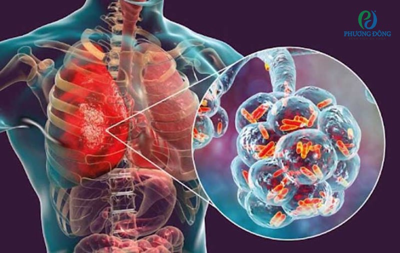 Viêm phổi do phế cầu, còn được gọi là viêm phổi Streptococcus pneumoniae