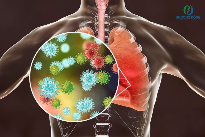 Viêm phổi do phế cầu lây truyền qua đường hô hấp