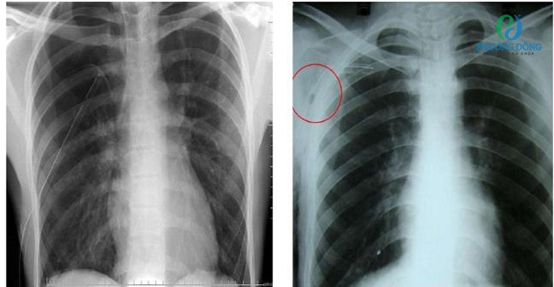 Viêm phổi thùy khi chụp x-quang