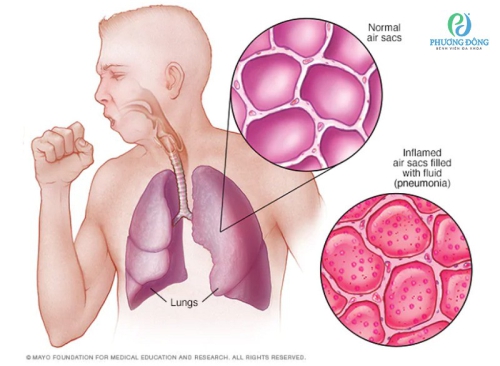 Những điều cần biết về bệnh viêm phổi có thể bạn chưa biết