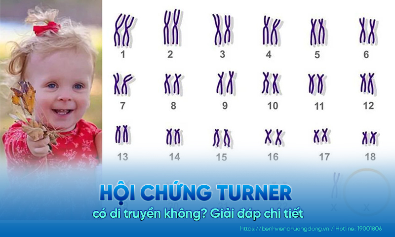 Giải đáp chi tiết: Hội chứng Turner có di truyền không?