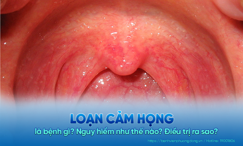 Loạn cảm họng là bệnh gì? Nguy hiểm như thế nào? Điều trị ra sao?