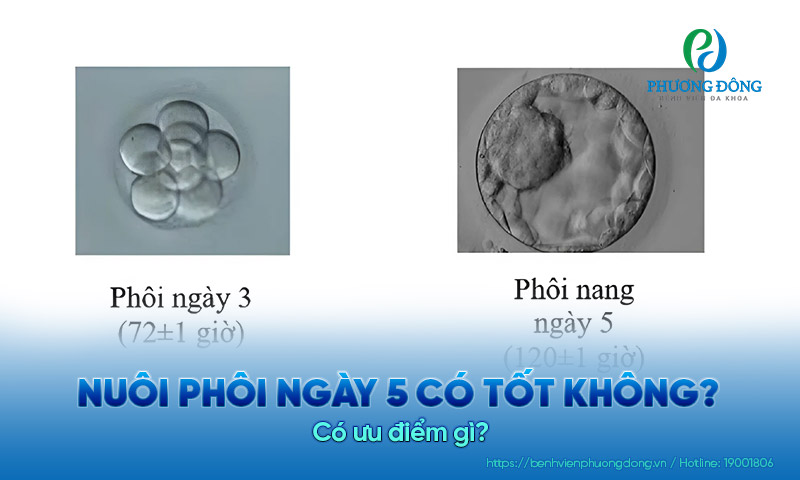 Nên chuyển phôi ngày 3 hay ngày 5 tốt hơn?