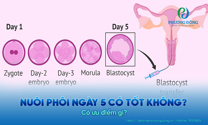 Nuôi phôi ngày 5 có tốt không? Có ưu điểm là gì?