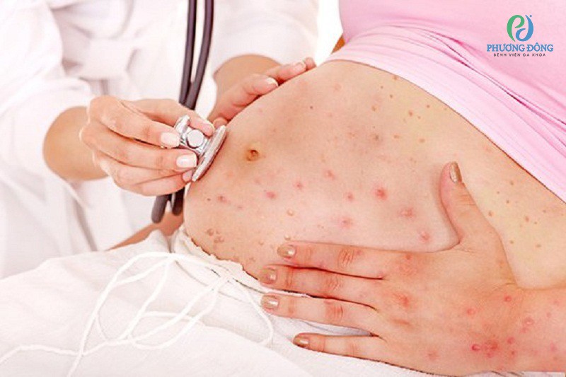 tiêm phòng rubella rồi có bị nữa không