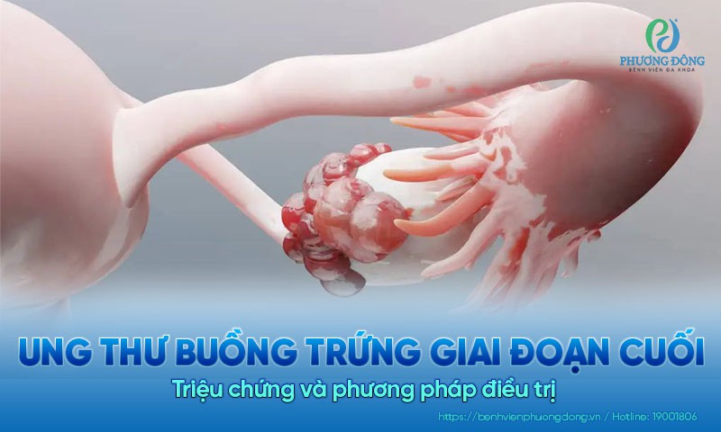 Ung thư buồng trứng giai đoạn cuối: Triệu chứng và phương pháp điều trị