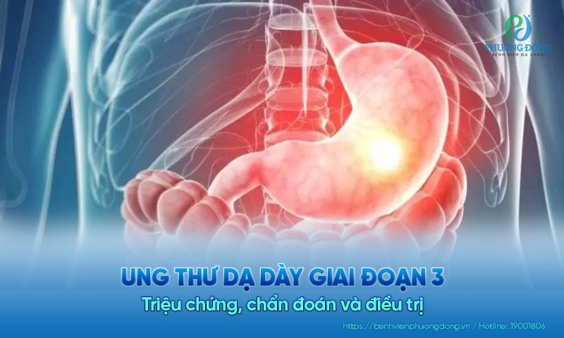 Ung thư dạ dày giai đoạn 3: Triệu chứng, chẩn đoán và điều trị