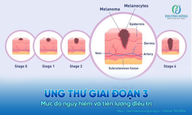 Ung thư giai đoạn 3: Mức độ nguy hiểm và tiên lượng điều trị