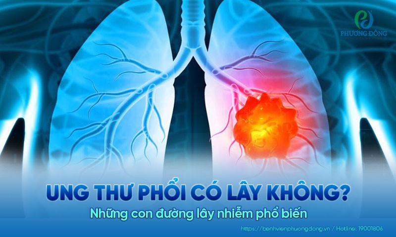 Ung thư phổi có lây không? Những con đường lây nhiễm phổ biến