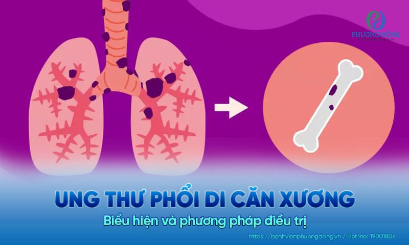 Ung thư phổi di căn xương: Biểu hiện và phương pháp điều trị