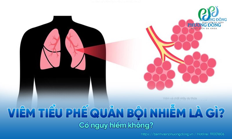 Viêm tiểu phế quản bội nhiễm là gì? Có nguy hiểm không?