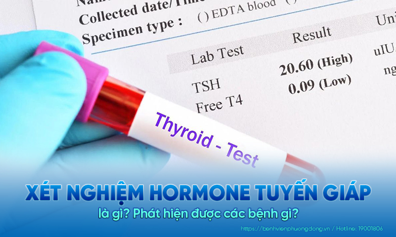 Xét nghiệm hormon tuyến giáp là gì? Phát hiện được các bệnh gì?