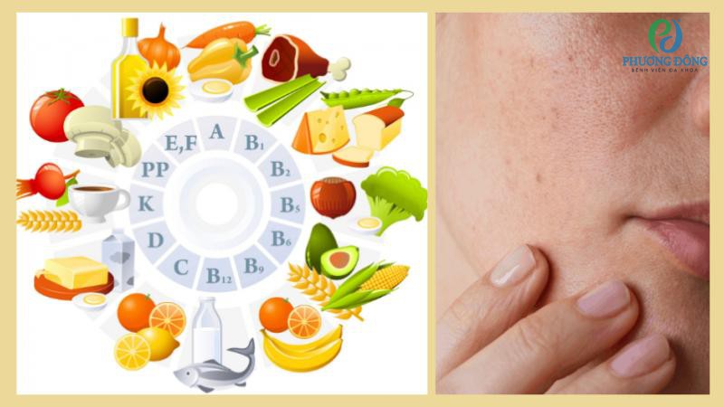 Da khô do thiếu dưỡng chất thì nên bổ sung đầy đủ các nhóm vitamin A,B, C, D, E