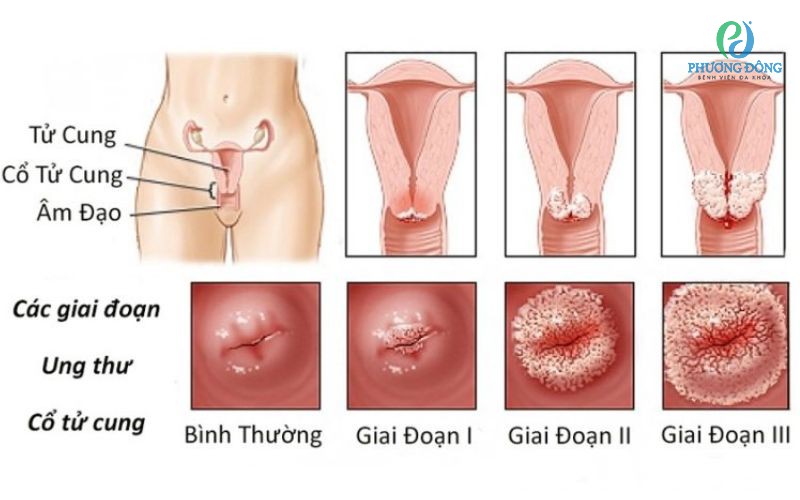 Ung thư tử cung có chữa khỏi không?