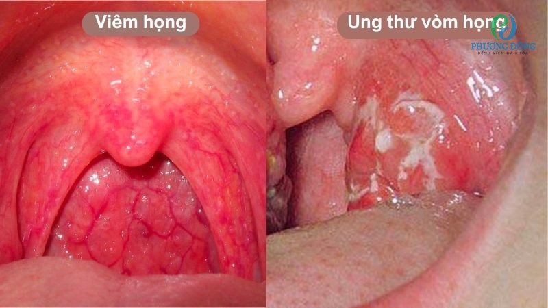 Viêm họng hạt không phải yếu tố nguy làm tăng nguy cơ hình thành ung thư