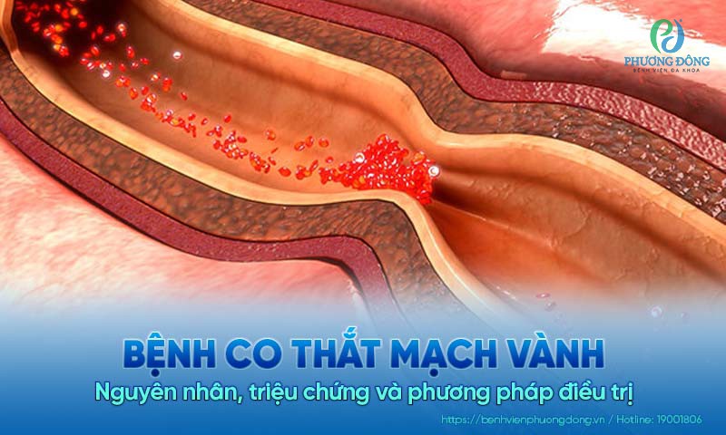 Bệnh co thắt mạch vành: Nguyên nhân, triệu chứng và cách điều trị