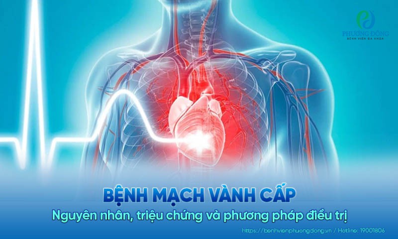 Bệnh mạch vành cấp: Nguyên nhân, triệu chứng và cách điều trị