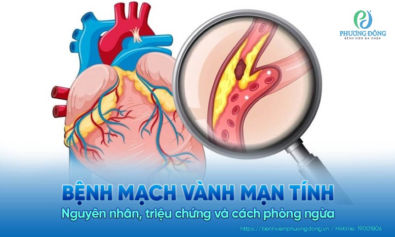 Bệnh mạch vành mạn tính: Nguyên nhân, triệu chứng và cách phòng ngừa