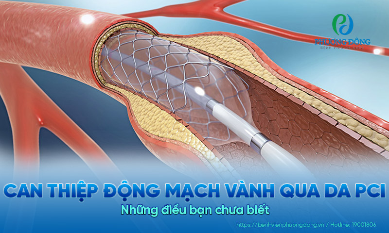 Can thiệp động mạch vành qua da (PCI): Những điều bạn chưa biết