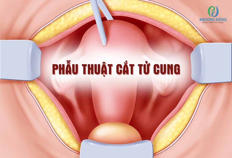 Có nên cắt tử cung khi bị u xơ?