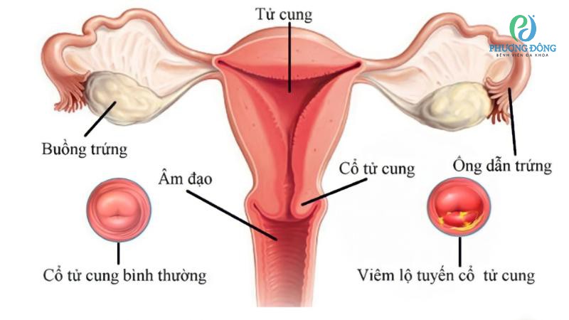 Viêm cổ tử cung lộ tuyến có thai được không?