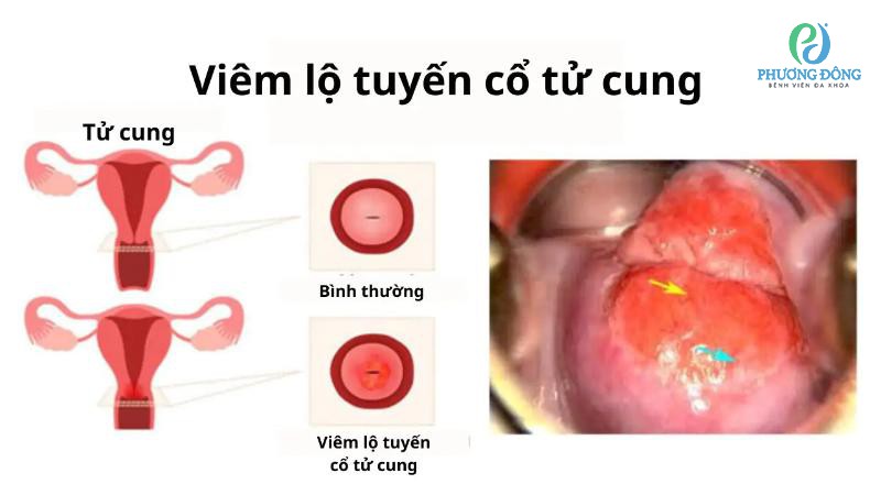 Vẫn có thể mang thai mặc dù bị viêm cổ tử cung lộ tuyến