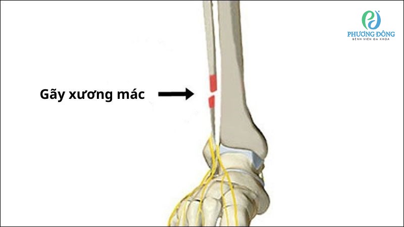 Gãy xương mác có nguy hiểm không? Các trường hợp có thể xảy ra