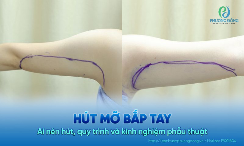 Hút mỡ bắp tay: Ai nên hút, quy trình và kinh nghiệm phẫu thuật