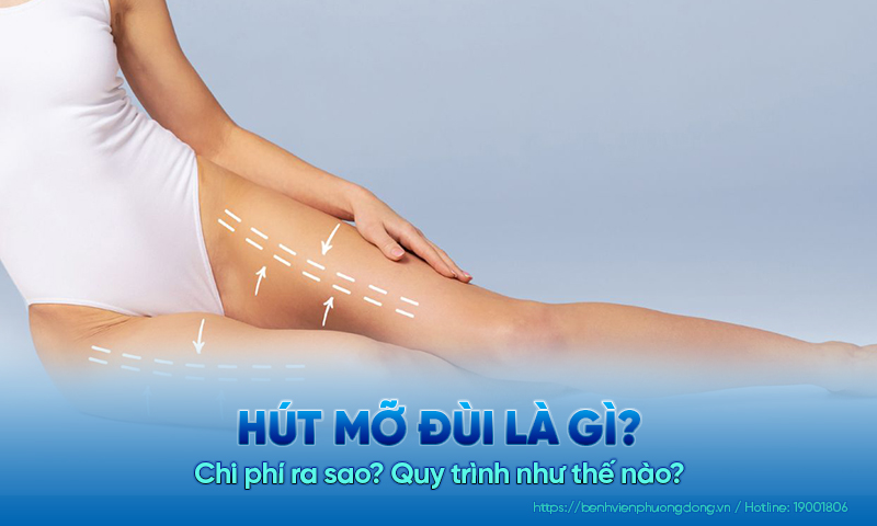 Hút mỡ đùi là gì? Chi phí ra sao? Quy trình như thế nào?