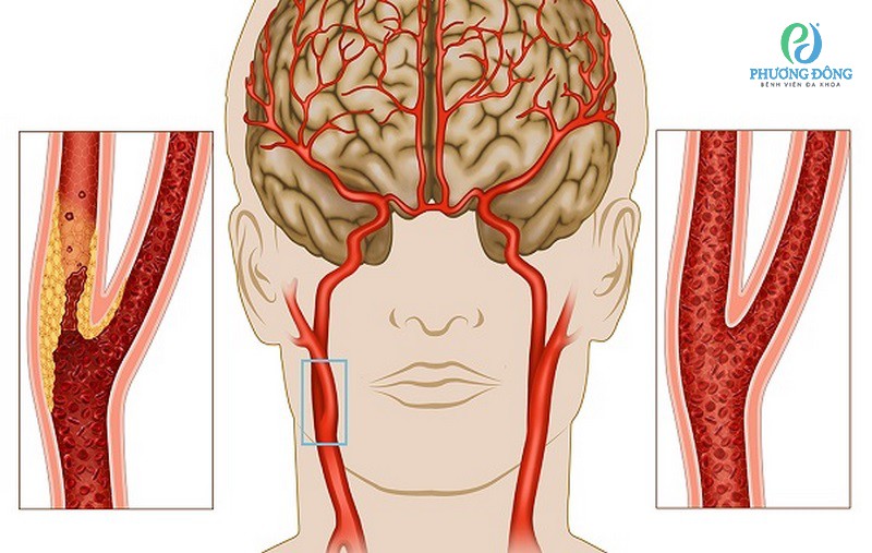 Làm xét nghiệm gì để biết thiếu máu não? Phương pháp chuẩn đoán?