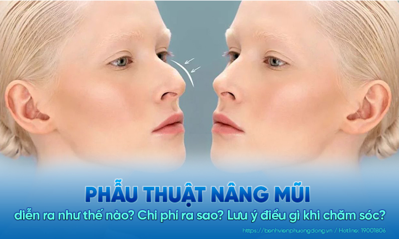 Nâng mũi diễn ra như thế nào? Chi phí? Lưu ý điều gì khi chăm sóc?