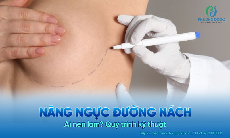 Nâng ngực đường nách dành cho ai? Quy trình kỹ thuật