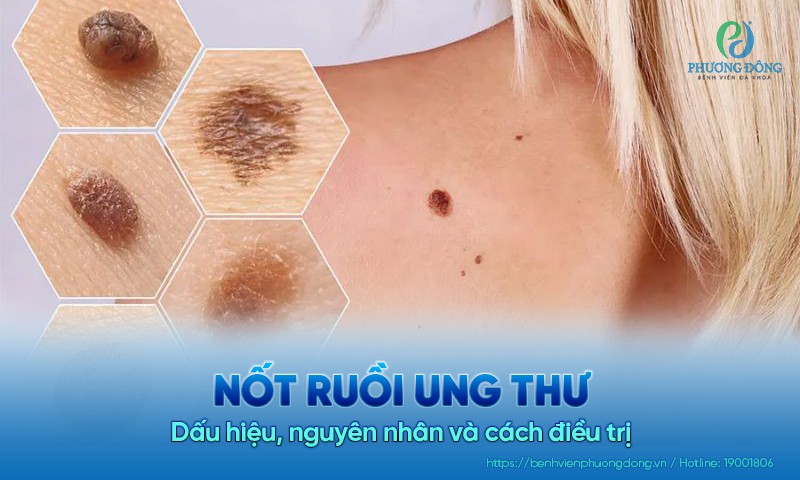 Nốt ruồi ung thư: Dấu hiệu, nguyên nhân và cách điều trị