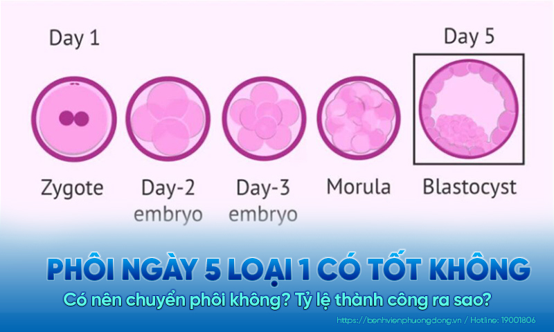 Phôi ngày 5 loại 1 có tốt không? Có nên chuyển phôi không? Tỷ lệ thành công ra sao?