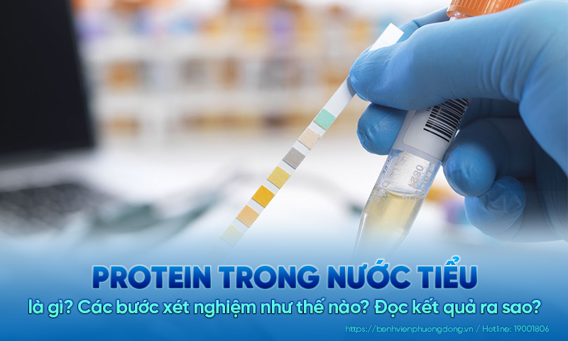 Protein trong nước tiểu là gì? Các bước xét nghiệm như thế nào? Đọc kết quả ra sao?