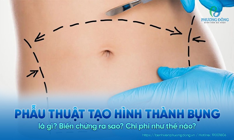 Phẫu thuật tạo hình thành bụng là gì? Chi phí như thế nào?