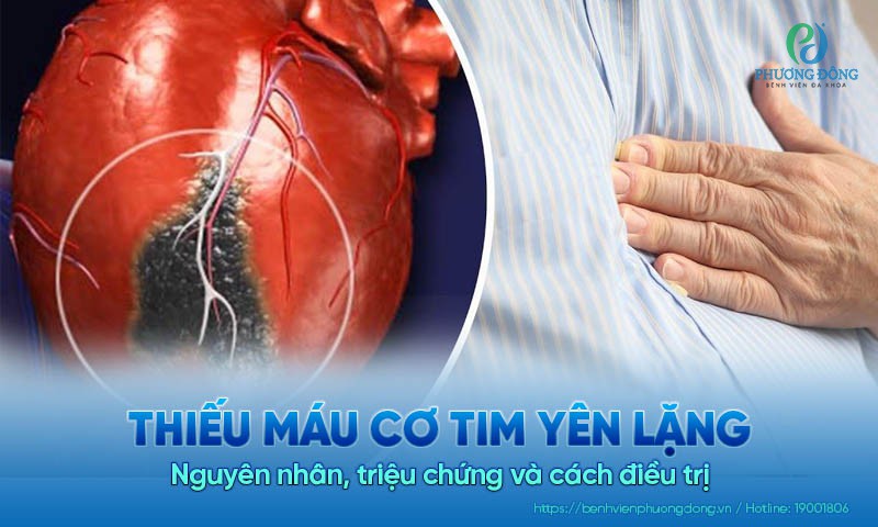 Thiếu máu cơ tim yên lặng: Nguyên nhân, triệu chứng và cách điều trị