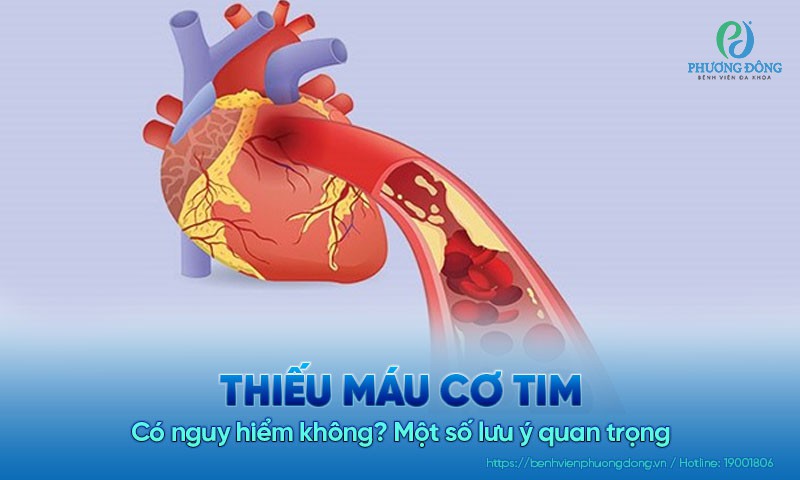 Thiếu máu cơ tim có nguy hiểm không? Một số lưu ý quan trọng