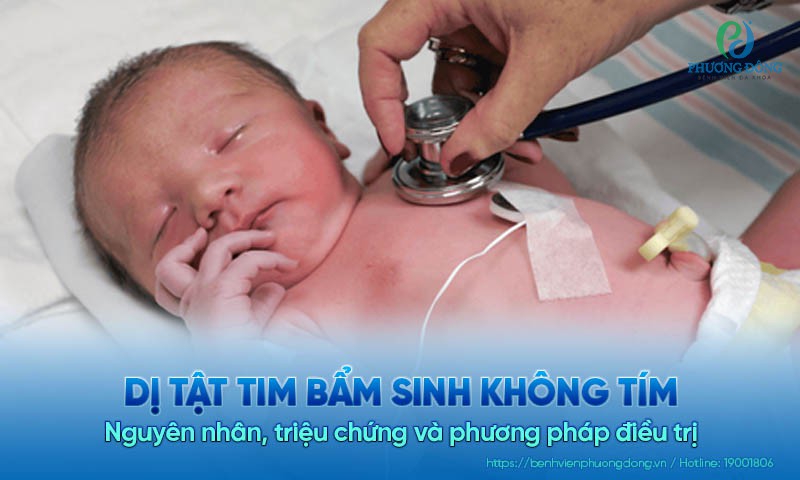 Dị tật tim bẩm sinh không tím: Nguyên nhân, triệu chứng và cách điều trị