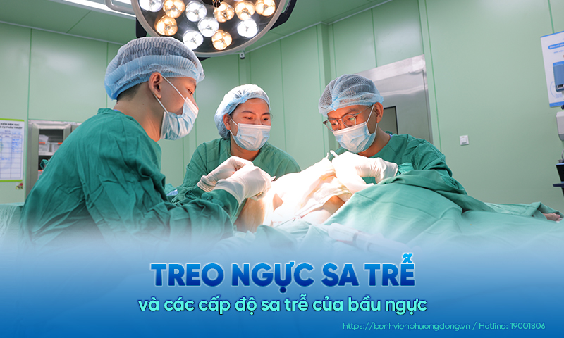 Treo ngực sa trễ và các cấp độ sa trễ của bầu ngực