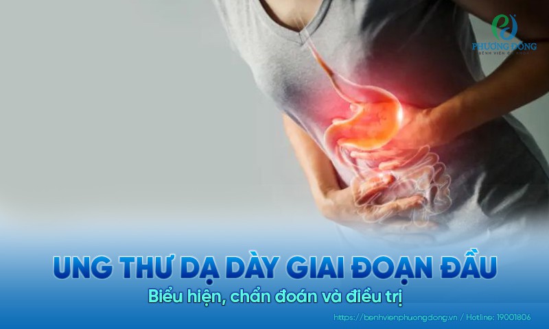 Ung thư dạ dày giai đoạn đầu: Biểu hiện, chẩn đoán và điều trị