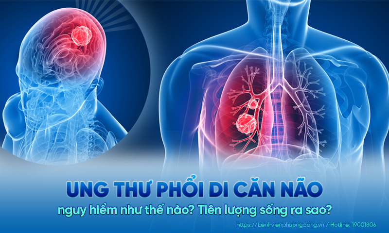 Ung thư phổi di căn não nguy hiểm như thế nào?